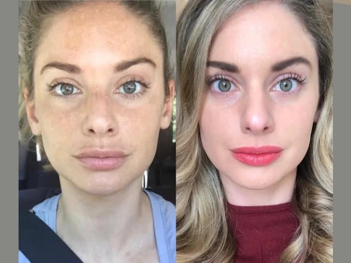 Best Choices for Radiofrequency (RF) Microneedling Best Doctors in dubai