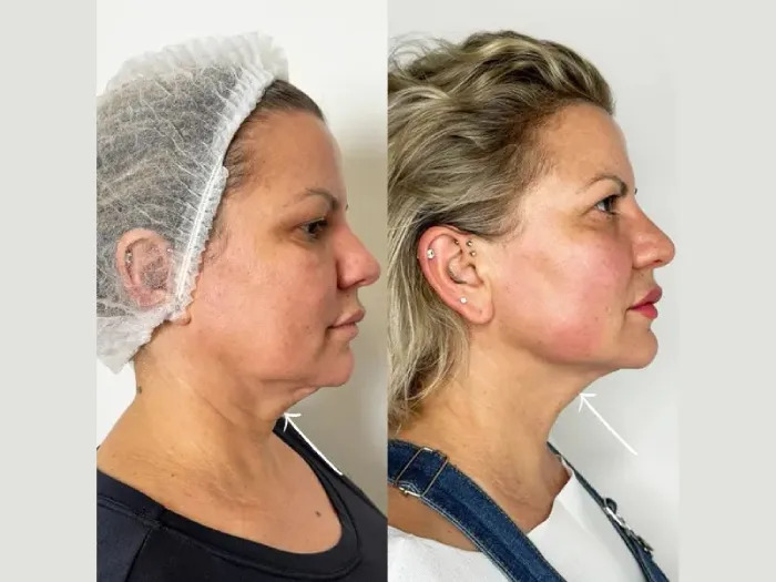Endolift vs Traditional Facelift: Insights from the Best Doctors in Dubai
