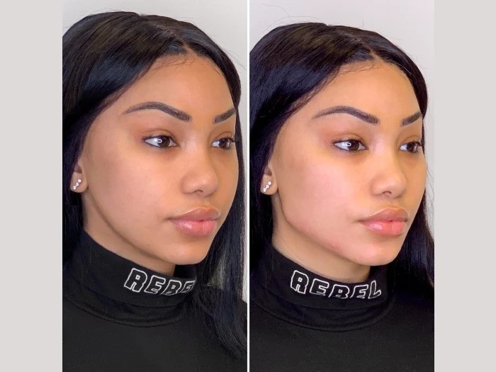 Best Doctors in Dubai Recommend Thread Lift For Non-Surgical Anti-Aging