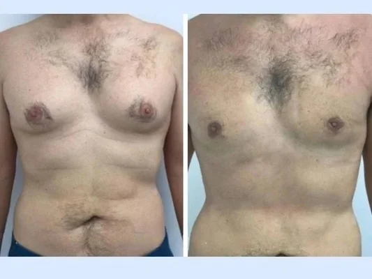 Gynecomastia in Dubai: How to Choose the Best Surgeon for Safe and Effective Results