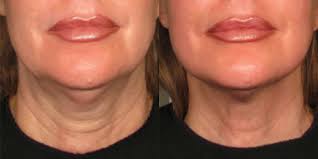 How Long Do Results from Ultherapy London Last?