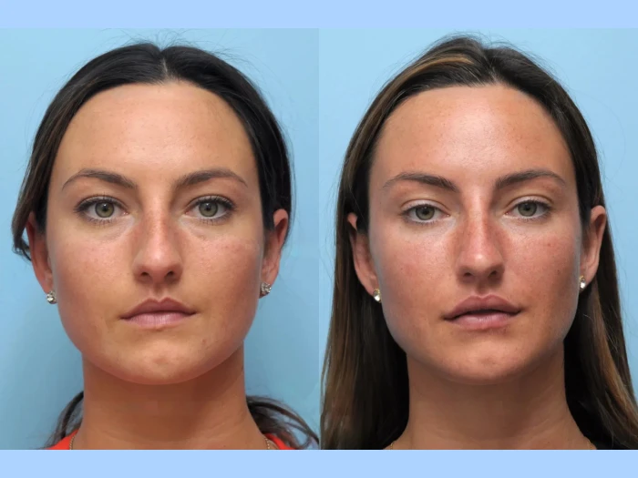 Best Doctors in Dubai for Thread Lift Facelifts That Enhance Natural Beauty