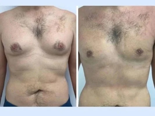 Achieve Confidence with Expert Gynecomastia in Dubai
